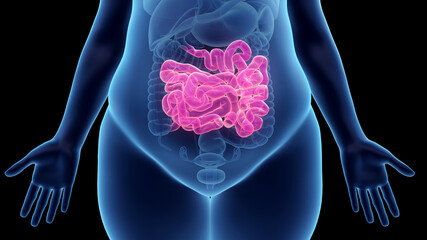 3d rendered illustration of an obese womans small intestine - obrazy, fototapety, plakaty
