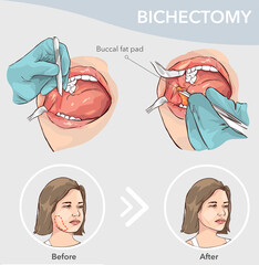 Buccal fat pad removal before and after vector illustration