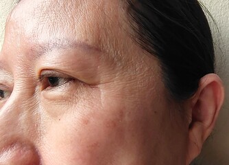 Portrait problems blemishes and dark spots skin beside on the face, concept healthcare, close up eyelid beside the eye.