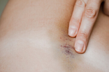 bruises and bruises on the girl's legs.