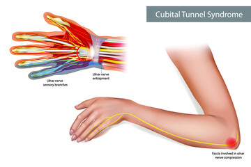 Medical illustration to explain Cubital tunnel syndrome. Ulnar nerve entrapment. Fascia involved in ulnar nerve compression. Vector