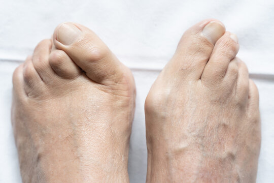 Top view of male feet together with big bunions and hammer toes over white background. Medical surgery, health care, podiatrist, dermatology concepts