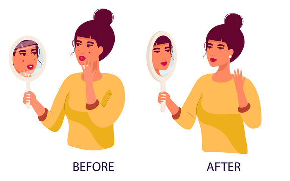 Set Of Women Sad Young Woman Hand Mirror Worrying About Her Acne On Face In Flat Design. Pimple Problem On Female Skin. And A Satisfied Girl With Her Skin Condition. Before After