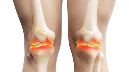 3d rendered illustration of painful knee joints
