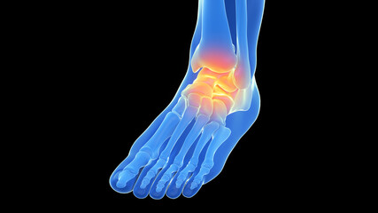 3d rendered illustration of a painful ankle joint