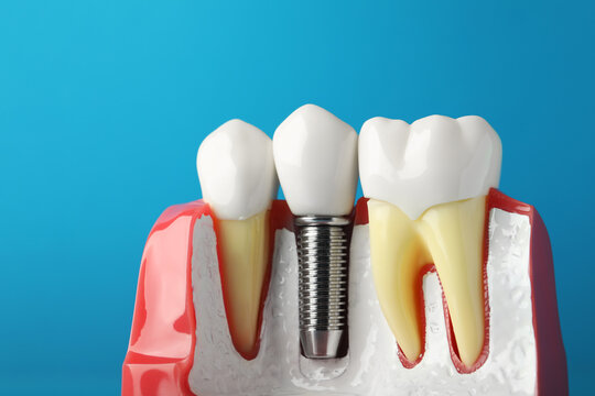 Educational model of gum with dental implant between teeth on light blue background, closeup