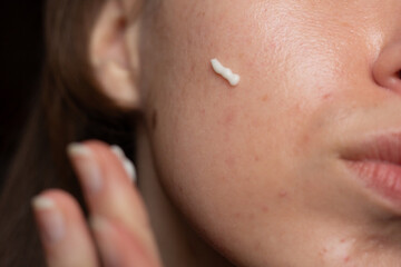 Closeup of a young woman applying prescription retinoid to her acne-prone skin with scarring and...