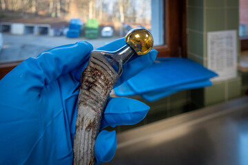 a complete explanted hip prosthesis lies on one hand with a blue medical glove