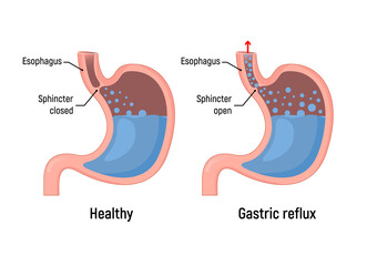Fototapeta Esophageal gastric reflux acid indigestion. Gastrointestial stomach heartburn gerd gastric reflux obraz