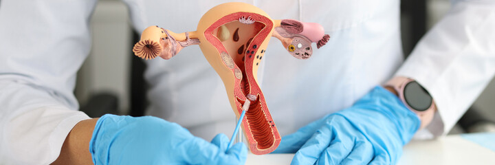 Gynecologist holds model of female reproductive system and cytological brush
