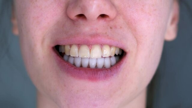 Teeth of woman with white veneers on lower and her yellow upper teeth, mouth closeup. Cosmetic stomatology dentistry concept. Malocclusion of a young woman.