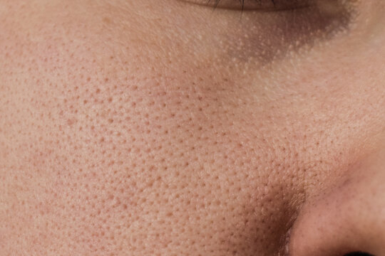 The skin of a woman's cheek with clogged pores before cleaning