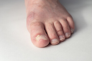 Toenail fungus on foot of a person. Damaged toenail