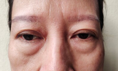 close up portrait flabbiness adipose skin under the eyes of woman, gloomy eyes, concept healthcare.
