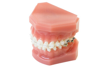 歯科矯正　模型　白背景イメージ