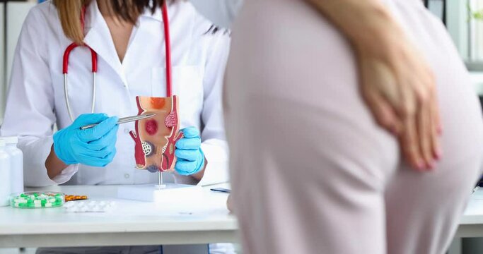 Doctor holds a model of unhealthy lower rectum with inflamed vascular structures
