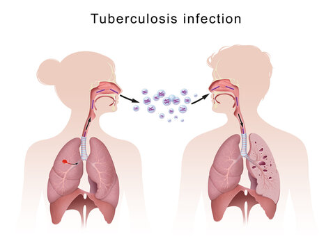 Tuberculosis is spread from one person to the next through the air