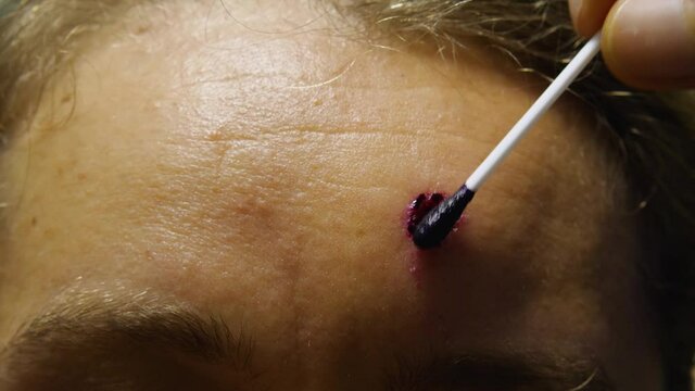 Close-up of a woman's forehead with a fresh wound after a mole removal. A cotton swab is used to treat the wound with a red disinfectant