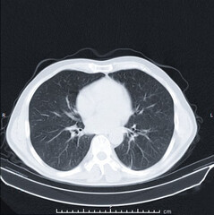 Computed Tomography slice of the lungs with application of edge enhancement filter that improve the conspicuity of lung parenchima's edges.