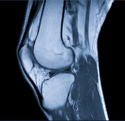 Magnetic Resonance images of The Knee joint Sagittal Proton density Images (MRI Knee joint) showing...