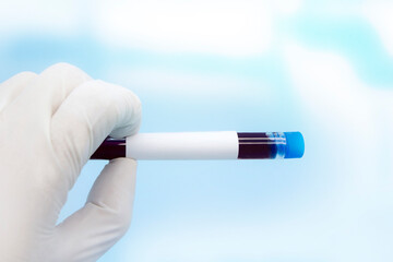 test blood tube in medical laboratory