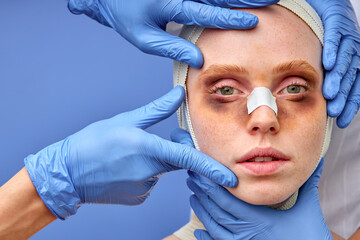 caucasian woman is wrapped with bandage, has bruises around eyes, after operation, isolated over...