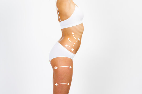 Cellulite removal scheme on body girl. White arrows markings on body young woman. Plastic surgery body.