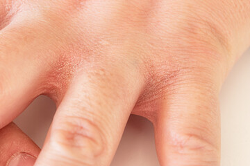 Concept of extremely dry and dehydrated skin of the hands. Painful fissures of the hands. Principle...