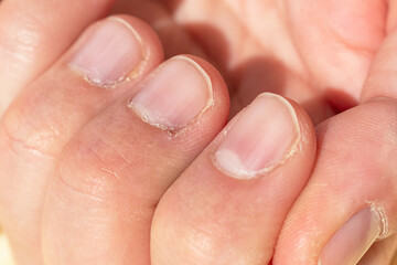 Close up on a male hands with dry skin and hangnails. Cuticles in bad condition. Chapped and...