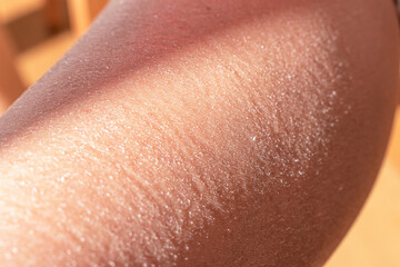 Concept of extremely dry and dehydrated skin of the body. Problem skin diagnosed with xerosi or...