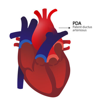 Patent ductus arteriosus. PDA in a anatomy heart illustration