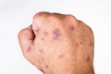 Allergic dermatitis on the skin of the hands to vaccine or medicine. Concept of health, skin care. White background.