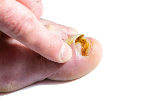 Tearing A Broken And Decomposed Big Toe Nail By The Index Finger Isolated On The White Background.