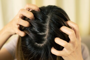 Itching and irritation of the scalp It makes us unable to bear having to constantly scratch our heads.