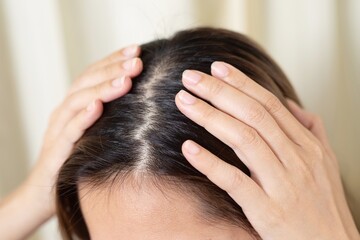 Dandruff is caused by yeast-like fungi (Malassezia) living on your scalp.