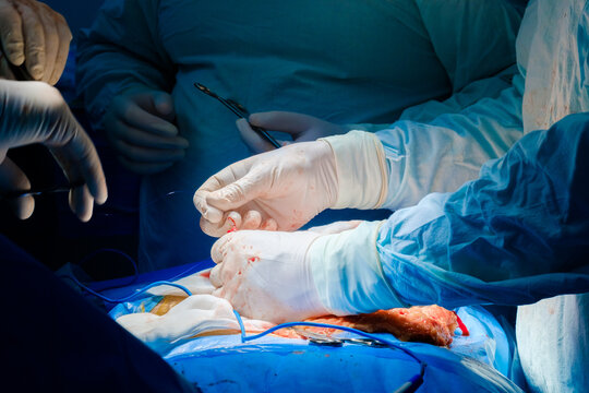 Stitching the patient's skin at the end of the surgical operation. Selective focus. The hands of surgeons in sterile gloves sew up an incision in the human skin.