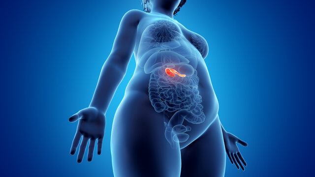 3d rendered illustration of an obese womans pancreas