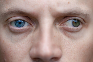 full face photo of a man with strabismus and blindness of one eye. visual disability - obrazy, fototapety, plakaty