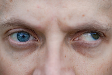 full face macro photo of a man with strabismus and blindness of one eye. visual disability - obrazy, fototapety, plakaty