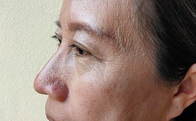 Obraz premium close up portrait flabbiness adipose skin on the eyelid, problem wrinkle skin beside the eye.