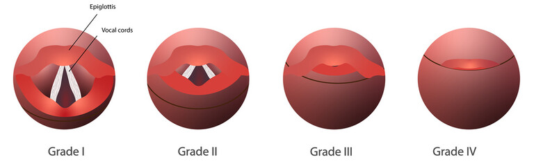 Cormack-Lehane system to assess the airway dificulty in intubation. Grade system to classifies laryngoscopy view. 