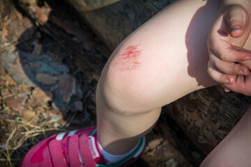 Wounded knee of the child, scratches and abrasions close up, safety concept. High quality photo