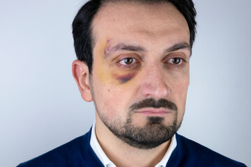 black eye after fall