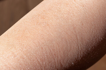 Concept of extremely dry and dehydrated skin of the body. Problem skin diagnosed with xerosi or...