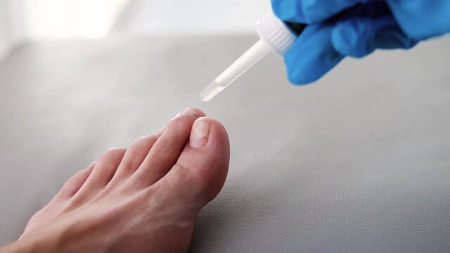 The doctor drips medicine from a pipette onto a sore finger. Close-up of a foot with nail fungus. Onycholysis: detachment of the nail from the nail bed.