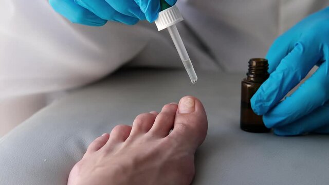 The doctor drips medicine from a pipette onto a sore finger. Close-up of a foot with nail fungus. Onycholysis: detachment of the nail from the nail bed.