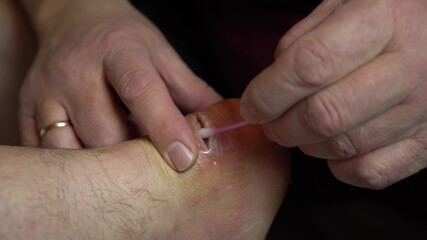 Wound treatment from suppuration with a cotton swab. Surgical incision of the ankle joint for inflammation.