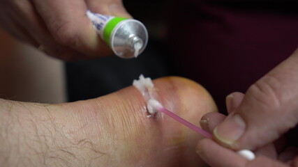 Application of ointment to heal a wound on the leg. Surgical incision of the ankle joint for...