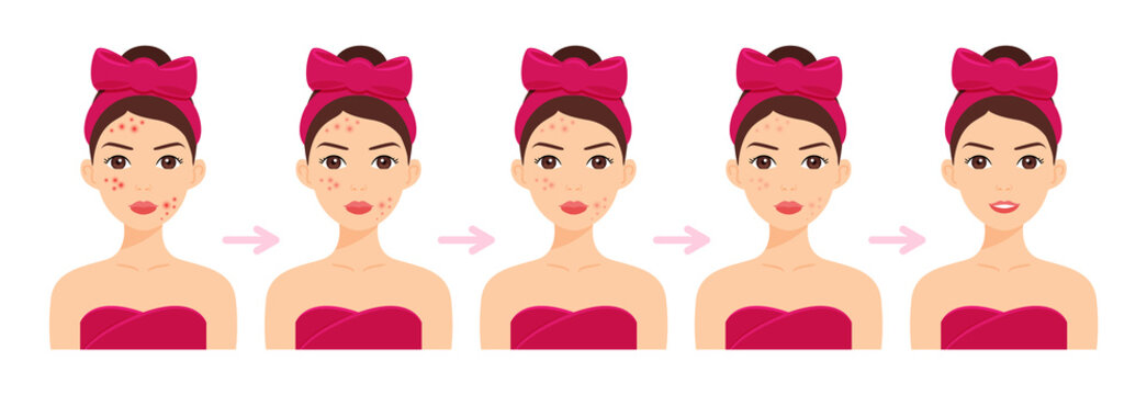 Cute Woman with Pimples on Face. Acne Treatment. Steps. Facial Skin Whitening. Stages. Happy Girl with a Smile and Clean Skin. Cartoon style. White background. Vector illustration for Beauty Design.