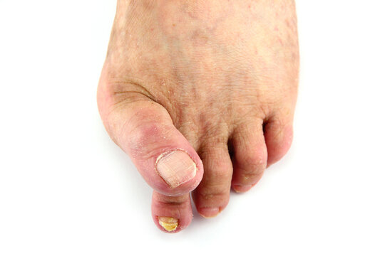 Sick feet with bunions, blisters and overlapped toes.